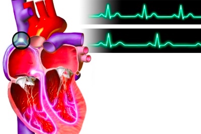 В новом анализе оценивалась взаимосвязь между наличием брадикардии и смертностью в зависимости от приема препаратов, снижающих частоту сердечных сокращений...