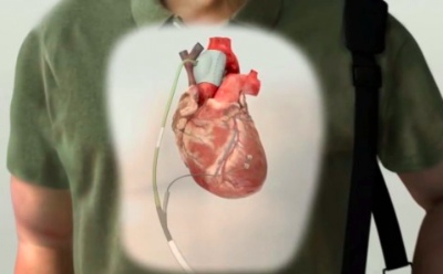 В журнале американского колледжа кардиологии представлены обнадеживающие результаты применения устройства с-pulse…