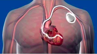 Авторы исследования пытались на основании уровня биомаркеров выделить пациентов, которым действительно необходима имплантация кардиовертера-дефибриллятора...
