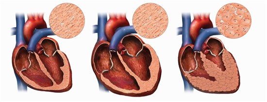 Профілактика раптової серцевої смерті у пацієнтів з ГКМП.