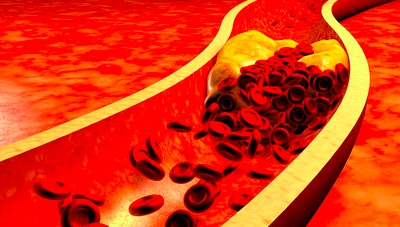 Авторы сравнивали два подхода к ведению пациентов с ишемической болезнью сердца и высоким сердечно-сосудистых риском в аспекте выявления и более агрессивного лечения заболеваний периферических артерий...