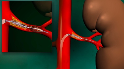 Целью исследования была оценки влияния стентирования почечных артерий у пациентов с их атеросклеротическим стенозом и гипертензией или ХБП