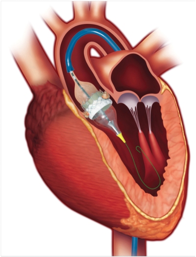 Апиксабан у пациентов с фибрилляцией предсердий после трансфеморальной замены аортального клапана. 