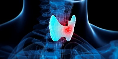 Риск развития ИБС и инсульта у пациентов с раком щитовидной железы, принимающих левотироксин. 