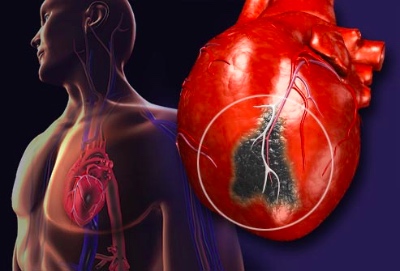 Эффективна ли клеточная терапия у пациентов с перенесенным инфарктом миокарда в уменьшении зоны постинфарктного кардиосклероза...