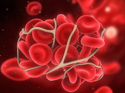 Новости научных сессий ACC 2017: Ривароксабан или аспирин для расширенной терапии венозной тромбоэмболии в исследовании EINSTEIN CHOICE. 