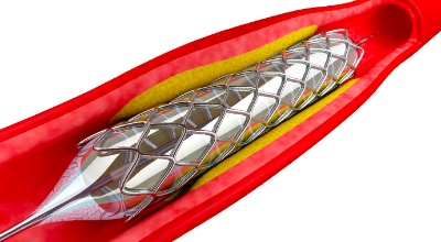 Продовжуються дослідження стосовно доцільності збільшення терміну прийому подвійної антитромбоцитарної терапії після стентування...