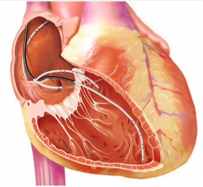 В новом исследовании авторы оценивали результаты ЭФИ в необходимости имплантации кардиовертера-дефибриллятора у пациентов после ИМ 