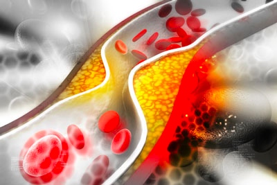 Авторы оценивали эффективность применения ингибитора PCSK9 эволокумаба в снижении риска неблагоприятных сердечно-сосудистых событий...