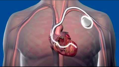 Эффективность имплантации кардиовертера-дефибриллятора у пациентов с неишемической кардиомиопатией...