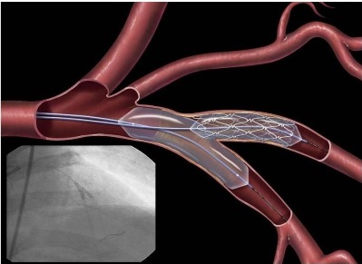 AUC 2017: критерии применения коронарной реваскуляризации у пациентов со стабильной ишемической болезнью сердца.