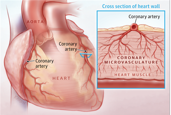 Коронарна мікросудинна дисфункція.