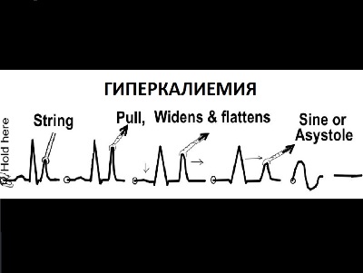 Новости научных сессий AHA 2016: риск гиперкалиемии на фоне терапии пациентов с СН в исследовании PARADIGM-HF.