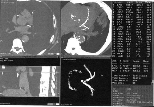 Рис. 2. Колькісна оцінка кальцинозу коронарних артерій за методом A.Agatston з використанням спеціальної комп’ютерної програми.
