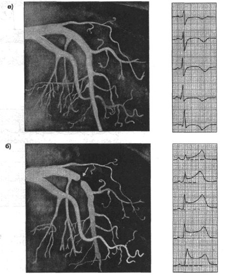 Мал.2. Коронароангіограма, зареєстрована у хворого ІХС із вазоспастичною стенокардією до (а) і під час (б) ергоновинового тесту.